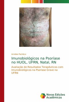 Imunobiológicos na Psoríase no HUOL, UFRN, Natal, RN - Pachêco, Arnóbio