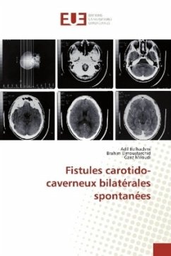 Fistules carotido-caverneux bilatérales spontanées - Belhachmi, Adil;Elmoustarchid, Brahim;Miloudi, Gzaz