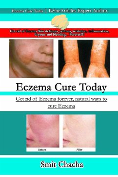 Eczema Cure Today - Get rid of Eczema forever natural ways to cure Eczema - Chacha, Smit