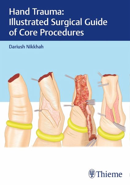 Hand Trauma: Illustrated Surgical Guide of Core Procedures (eBook, PDF) Hand Trauma: Illustrated Surgical Guide of Core Procedures (eBook, PDF)