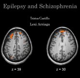 Epilepsy and Schizophrenia (eBook, PDF)
