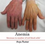 Anemia (decrease in number of red blood cells) (eBook, PDF)