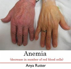 Anemia (decrease in number of red blood cells) (eBook, PDF) - Rutter, Anya