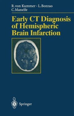 Early CT Diagnosis of Hemispheric Brain Infarction (eBook, PDF) - Kummer, Rüdiger V.; Bozzao, Luigi; Manelfe, Claude