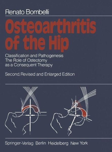 Osteoarthritis of the Hip (eBook, PDF) Osteoarthritis of the Hip (eBook, PDF)