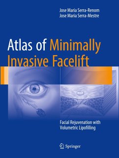 Atlas of Minimally Invasive Facelift - Serra-Renom, Jose Maria;Serra-Mestre, Jose Maria