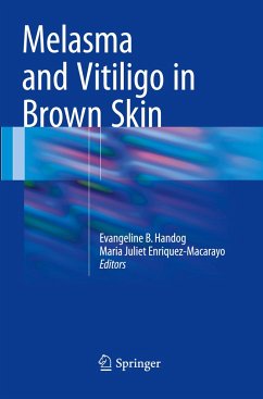 Melasma and Vitiligo in Brown Skin