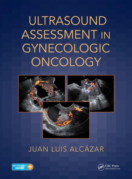 Ultrasound Assessment in Gynecologic Oncology (eBook, PDF) Ultrasound Assessment in Gynecologic Oncology (eBook, PDF)