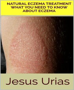 Natural Eczema Treatment (eBook, ePUB) - Urias, Jesus