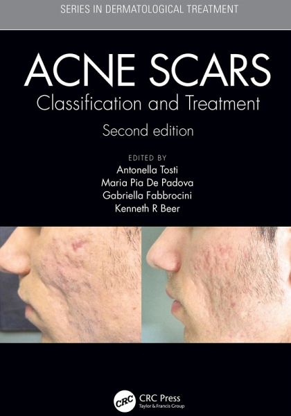 Acne Scars (eBook, ePUB) Acne Scars (eBook, ePUB)