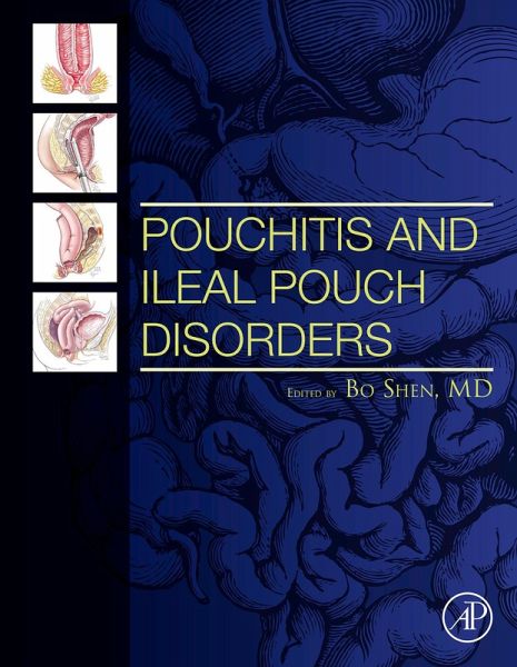 Pouchitis and Ileal Pouch Disorders (eBook, ePUB)