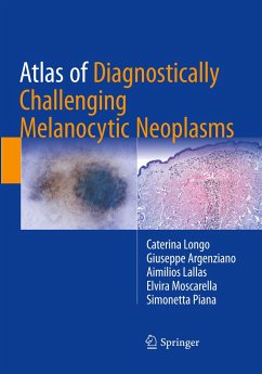 Atlas of Diagnostically Challenging Melanocytic Neoplasms - Longo, Caterina;Argenziano, Giuseppe;Lallas, Aimilios