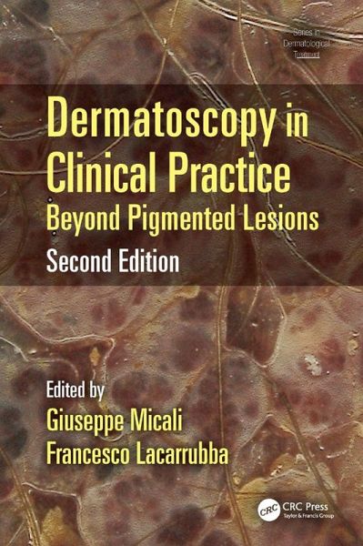 Dermatoscopy in Clinical Practice (eBook, PDF) Dermatoscopy in Clinical Practice (eBook, PDF)