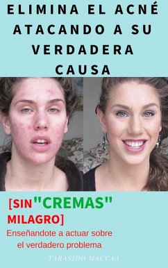 Cover Elimina El Acne Atacando a Su Verdadera Causa (eBook, ePUB)