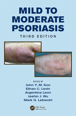 Cover Mild to Moderate Psoriasis (eBook, ePUB)