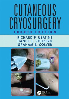 Cutaneous Cryosurgery (eBook, ePUB) - Usatine, Richard P.; Stulberg, Daniel L.; Colver, Graham B.