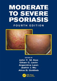 Cover Moderate to Severe Psoriasis (eBook, ePUB)