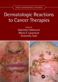 Dermatologic Reactions to Cancer Therapies (eBook, PDF) Cover Dermatologic Reactions to Cancer Therapies (eBook, PDF)