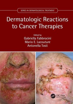 Dermatologic Reactions to Cancer Therapies Cover Dermatologic Reactions to Cancer Therapies