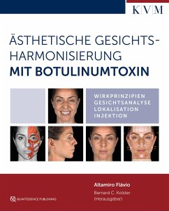 Ästhetische Gesichtsharmonisierung mit Botulinumtoxin - Flávio, Altamiro