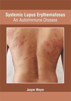 Systemic Lupus Erythematosus: An Autoimmune Disease