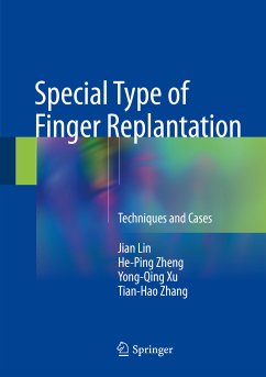 Special Type of Finger Replantation (eBook, PDF) - Lin, Jian; Zheng, He-Ping; Xu, Yong-Qing; Zhang, Tian-Hao