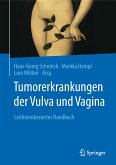 Tumorerkrankungen der Vulva und Vagina (eBook, PDF)
