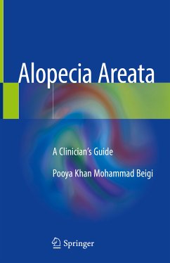 Alopecia Areata (eBook, PDF) - Khan Mohammad Beigi, Pooya