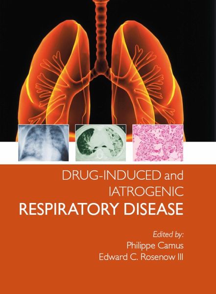 Drug-induced and Iatrogenic Respiratory Disease (eBook, ePUB) Drug-induced and Iatrogenic Respiratory Disease (eBook, ePUB)