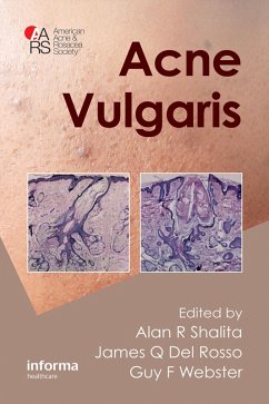 Acne Vulgaris (eBook, PDF)