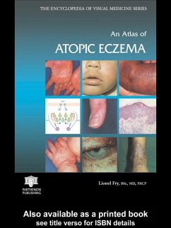An Atlas of Atopic Eczema (eBook, ePUB) - Fry, Lionel