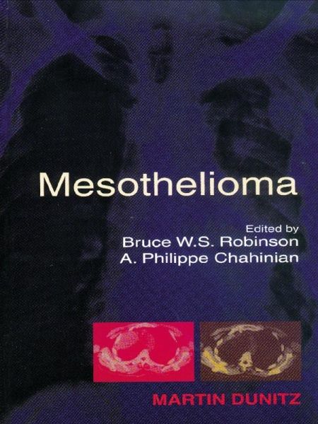 Mesothelioma (eBook, ePUB) Mesothelioma (eBook, ePUB)