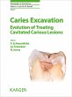 Caries Excavation: Evolution of... - Bild 1
