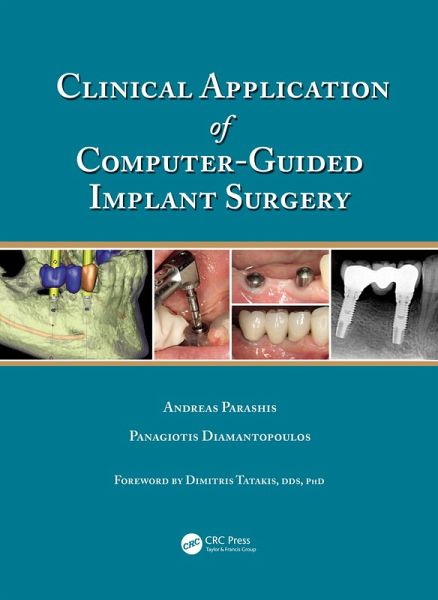 Clinical Application of Computer-Guided Implant Surgery (eBook, PDF)