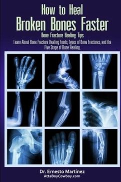How to Heal Broken Bones Faster. Bone Fracture Healing Tips - Martinez, Ernesto