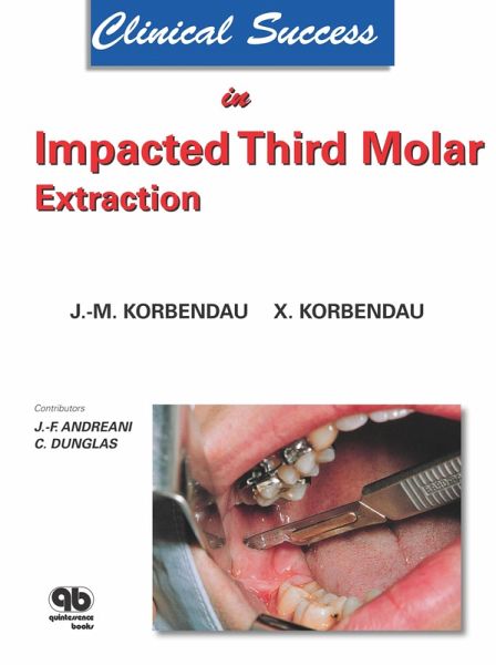Clinical Success in Impacted Third Molar Extraction (eBook, ePUB)