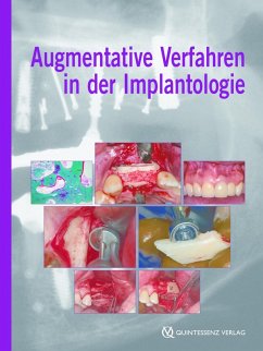 Augmentative Verfahren in der Implantologie (eBook, ePUB) - Khoury, Fouad