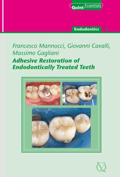 Cover Adhesive Restoration of Endodontically Treated Teeth (eBook, ePUB)