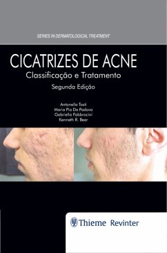 Cicatrizes de Acne (eBook, ePUB) - Tosti, Antonella; Beer, Kenneth R.; De Padova, Maria Pia; Fabbrocini, Gabriella