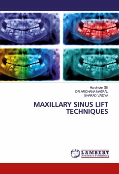 MAXILLARY SINUS LIFT TECHNIQUES