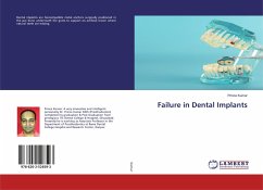 Failure in Dental Implants