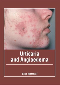 Urticaria and Angioedema Urticaria and Angioedema