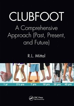 Clubfoot - Mittal, R L