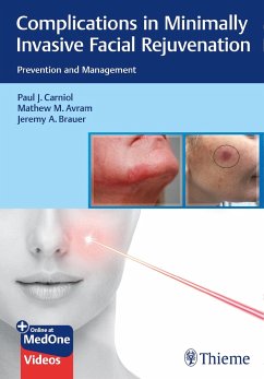 Complications in Minimally Invasive Facial Rejuvenation - Carniol, Paul J.;Avram, Mathew M.;Brauer, Jeremy A.