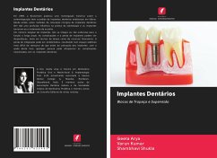 Implantes Dentários - Arya, Geeta;Kumar, Varun;Shukla, Shambhavi