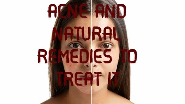 ACNE AND NATURAL REMEDIES TO TREAT IT (eBook, ePUB) ACNE AND NATURAL REMEDIES TO TREAT IT (eBook, ePUB)