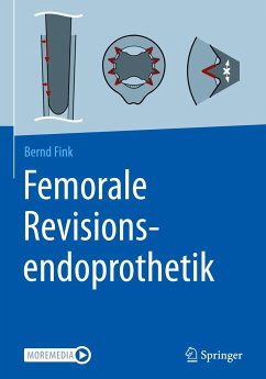 Femorale Revisionsendoprothetik - Fink, Bernd