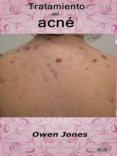 Tratamiento Del Acné (eBook, ePUB) - Jones, Owen