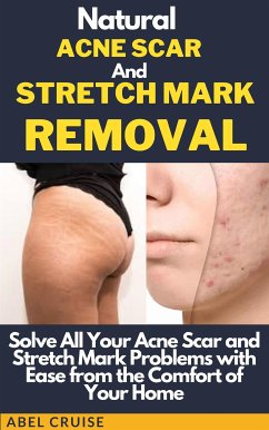 Natural Acne Scar and Stretch Mark Removal (eBook, ePUB) - Abel, Cruise