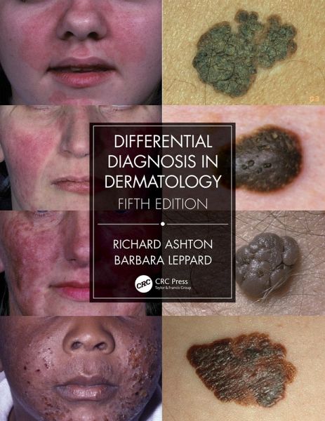 Differential Diagnosis in Dermatology (eBook, PDF) Differential Diagnosis in Dermatology (eBook, PDF)